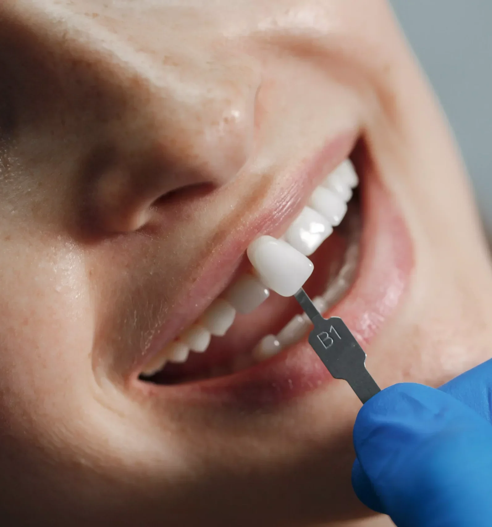 dentist-whiting-teeth